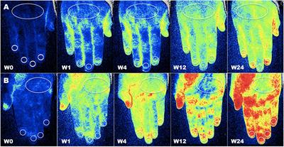 Aminaphtone Efficacy in Primary and Secondary Raynaud’s Phenomenon: A Feasibility Study